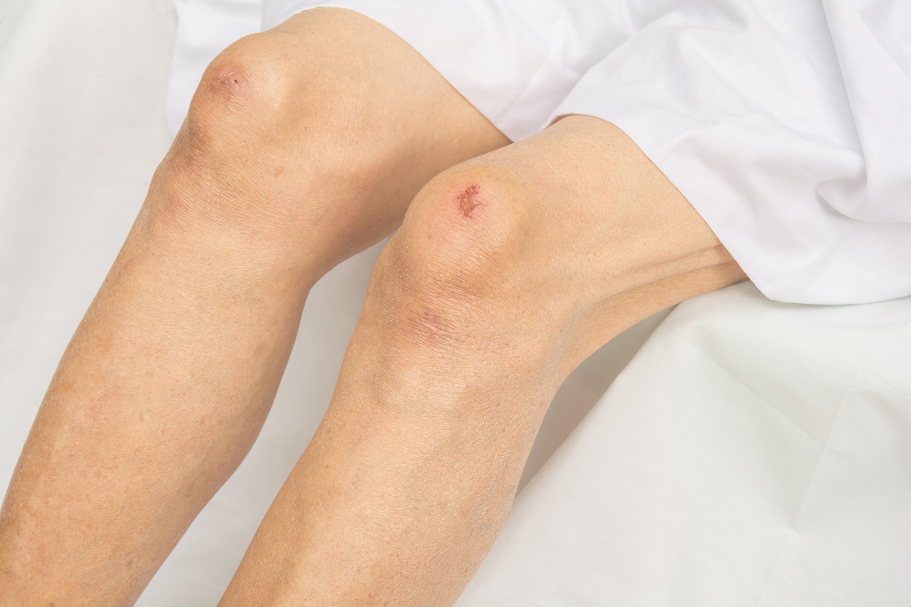 Suchość skóry u osób starszych